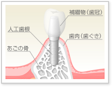 インプラント治療